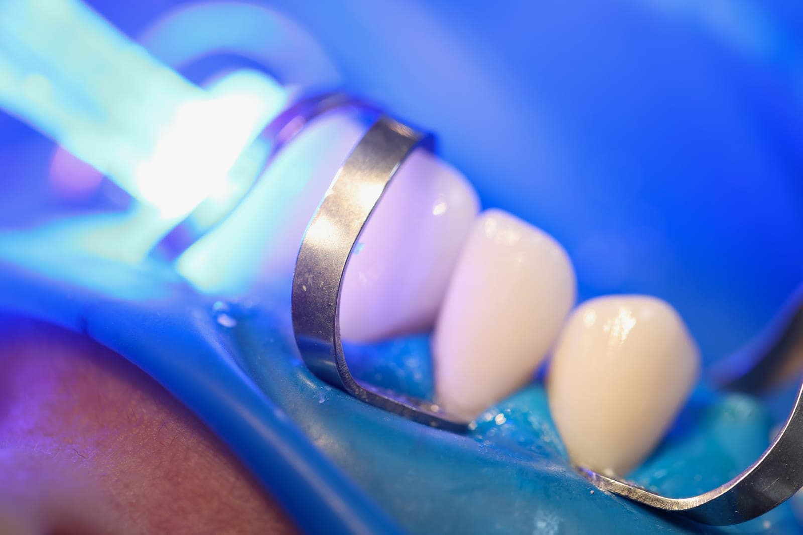 A natural-looking crown being fitted at Marchwood Dental Practice