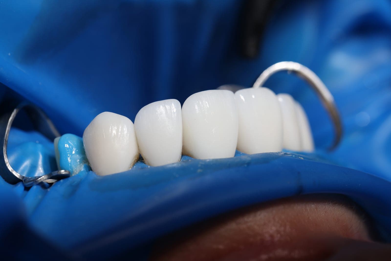 Close-up of natural-looking, tooth-coloured fillings at Marchwood Dental Practice